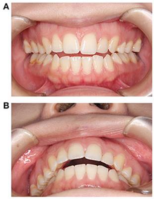 Case report: Open bite as an extrapyramidal side effect with aripiprazole, a dopamine partial agonist